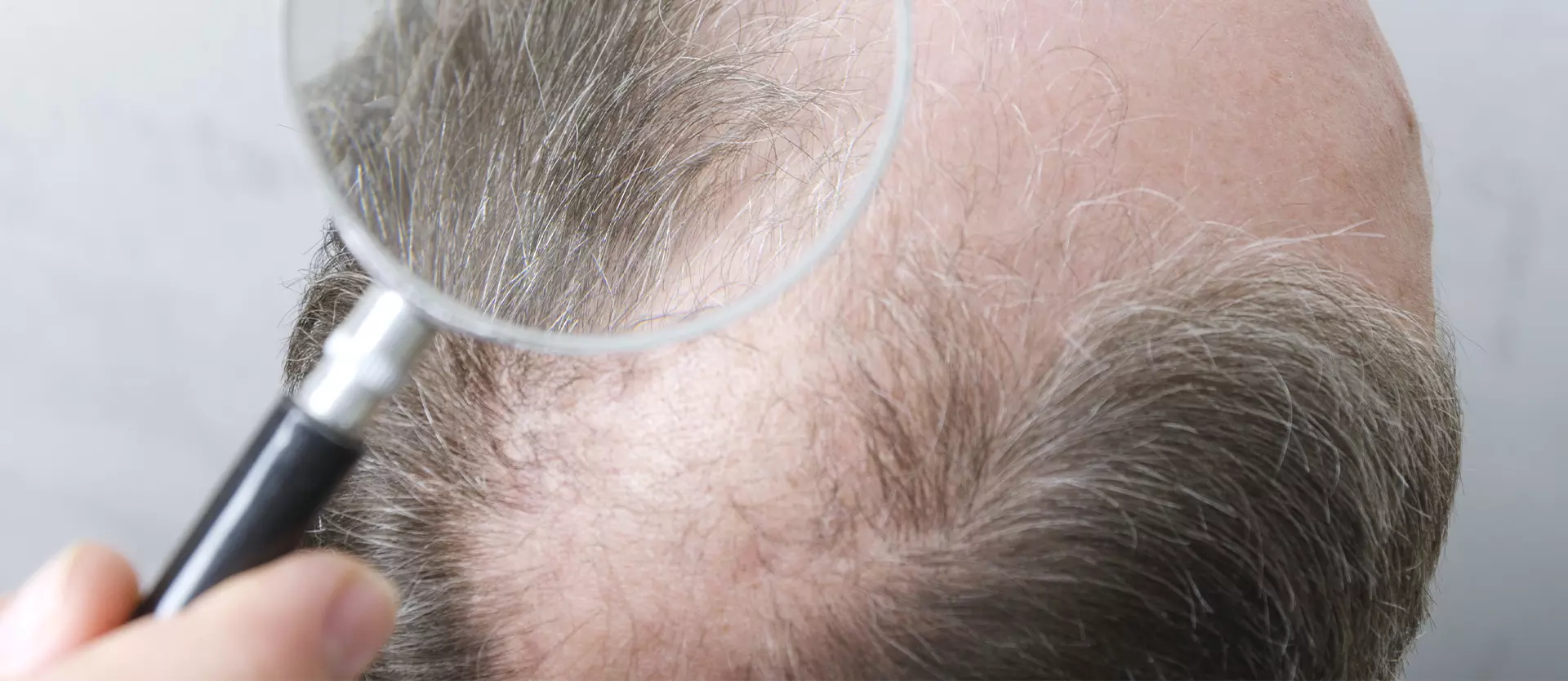 Understanding Hair Loss