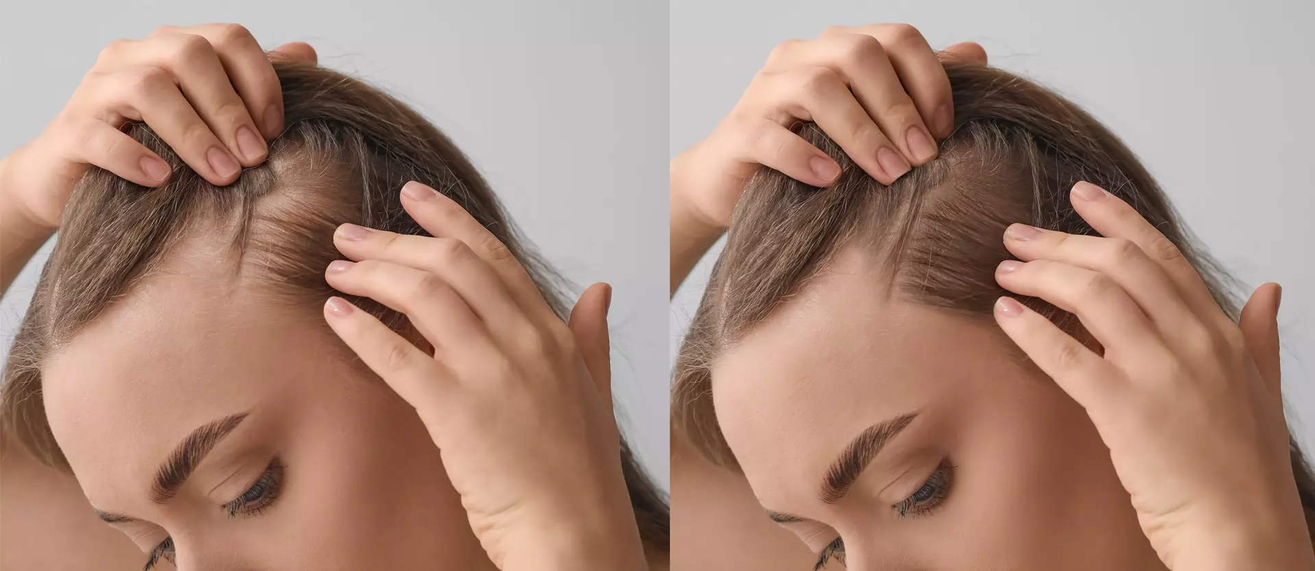 Hair Toppers Explained: A Simple Solution for Thinning Hair